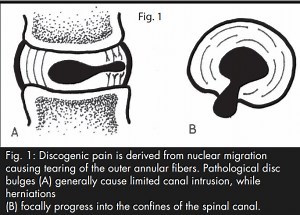 DRX9000 Yochum Study Research – True Spinal Decompression