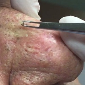 "Mr Wilson" is back!! If you want to see his story and follow what I have done to improve the shape of his nose and extract blackheads, go to my YouTube channel at DrSandraLee and look for Mr Wilson's playlist. I have 4 videos so far and a new one to follow soon! Enjoy! #mrwilson #drpimplepopper | Skin Physicians & Surgeons