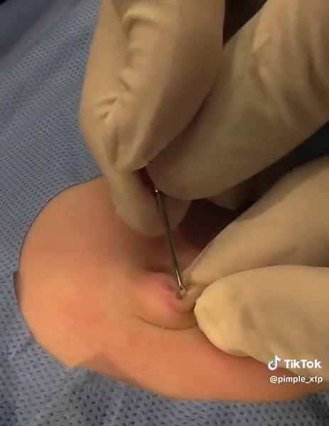 Belly Button Pearl Extraction and Acne Removal Videos