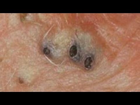 old blackheads extraction compilation
