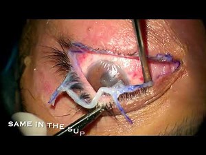 Amniotic membrane for ocular chemical injury