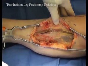 Single and Dual Incision Fasciotomy of the Lower Leg • Video • MEDtube.net