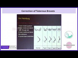 29 Correction of Tuberous Breasts