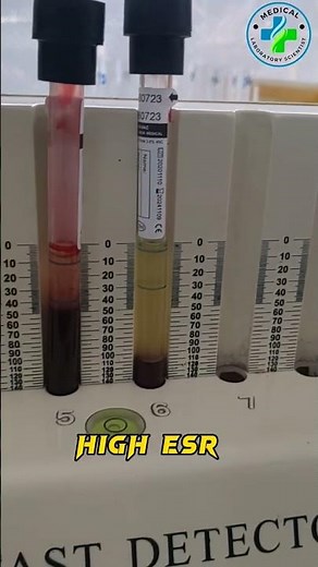ESR | Erythrocyte sedimentation rate | high ESR | high ESR causes | ESR test | hematology