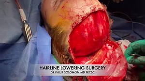 Hairline Lowering Surgery