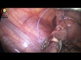 Laparoscopic Appendectomy for 12yrs Old Boy • Video • MEDtube.net