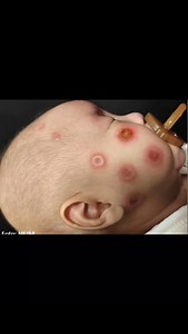 O que é o Lúpus Eritematoso Neonatal? Um bebê previamente saudável de 2 meses de idade e do sexo masculino foi apresentado a uma clínica dermatológica com um histórico de 2 semanas de placas anulares caracterizadas por bordas edematosas e crosta central sobre o rosto, escalpo e tronco. Resultados de análises sanguíneas (contagem de células sanguíneas) e metabólicas não apontaram nenhuma anormalidade. Análise de uma amostra das feridas na pele (biópsia) revelou dermatite de interface vacuolar e p