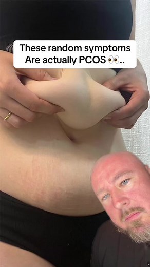 These are the PCOS symptoms no one connects… but they all come from the same place 👀 ⁣ Most women are told PCOS is just irregular periods or weight gain. But then this stuff starts happening… and it feels completely random. ⁣ ⚠️ Your scalp gets oily, flaky, irritated.. That’s not “just dandruff”… it’s often higher androgens pushing oil production into overdrive ⚠️ You notice darker skin around your neck or underarms.. That’s not a skin issue… it’s usually your body struggling with insulin prope