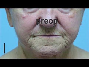 Laser Resurfacing in Virginia Beach Virginia for Facial Wrinkles