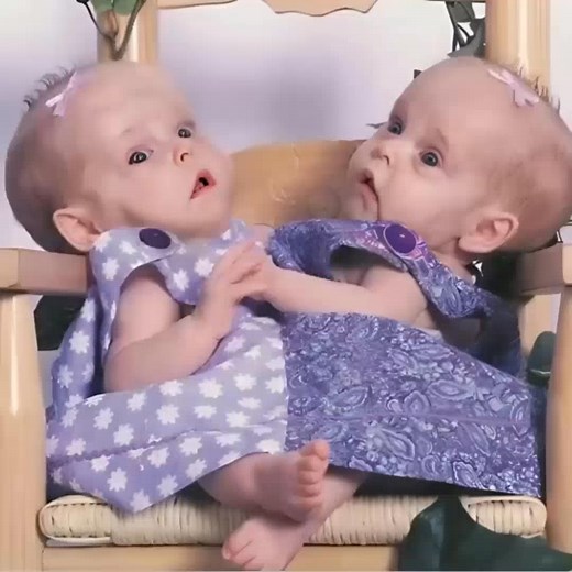 👧👧 These Siamese twins were separated 18 years ago, and everyone believed they wouldn’t survive. 😢 Today, after years of struggle, they’ve proven that miracles are real. ✨ 📌 See how the sisters live now – the touching story is in the comments. 👇👇 Read more in Comment or Most relevant -> All comments 👇 | Surprising World 17v