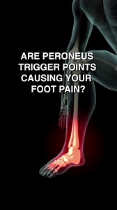 Are Peroneus Trigger Points Causing Your Foot Pain? 👉 Peroneus trigger points are areas of hypersensitivity that can develop in the peroneus muscles, located on the outer side of the lower leg. 👉 These trigger points can cause pain, discomfort, and weakness in the ankle, foot, and outer side of the leg. 👉 Addressing peroneus trigger points is important to maintain mobility and overall quality of life. The peroneus muscles, also known as the peroneals or fibularis muscles, are a group of muscl