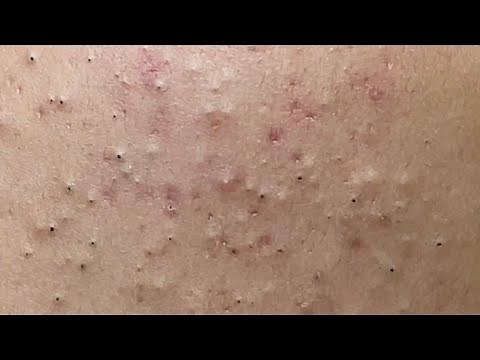 Acne treatment for Spa Linh Mun 2023 #042