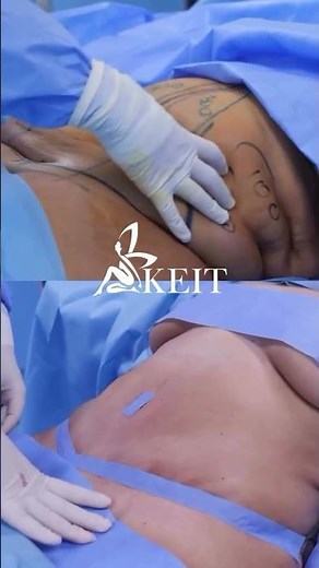 Abdominoplasty surgery - Before & After at KEIT Clinic