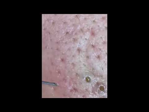 MULTIPLE BlackHeads GIANT Extraction (Blackheads Removal Videos 2022) / #4