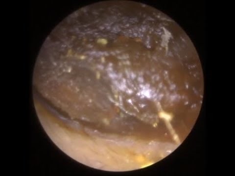 766 - Severely Retracted Eardrum Ear Wax Removal