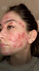 This woman finds confidence after living with cystic acne🥰 | Four Nine Looks