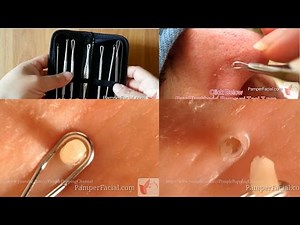 Stainless Steel Pimple Popping Tools