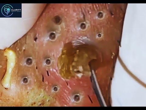 Deep Facial Cleansing Methods for Clear Skin | Relaxing Spa Routine #6716