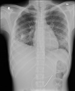 Cavitating pneumonia | Radiology Reference Article | Radiopaedia.org