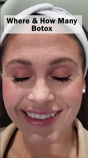 Where and How Many Botox Injection Did I Get in Total? Customized to your muscles!