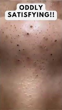 Removing large blackheads and pimples from face new 2026 #311
