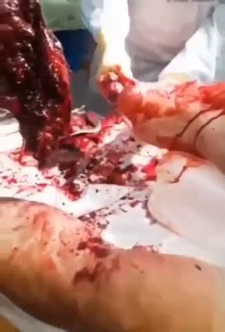 Soldier’s leg torn off by explosion • GoreCenter