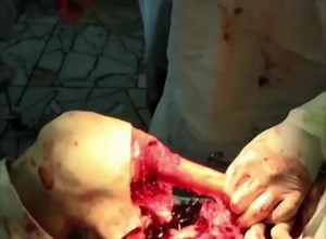 Leg Bone Amputation Process