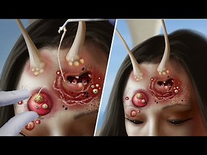 ASMR Treatment of pustules on the forehead｜Beware of deep phobia｜Remove parasites