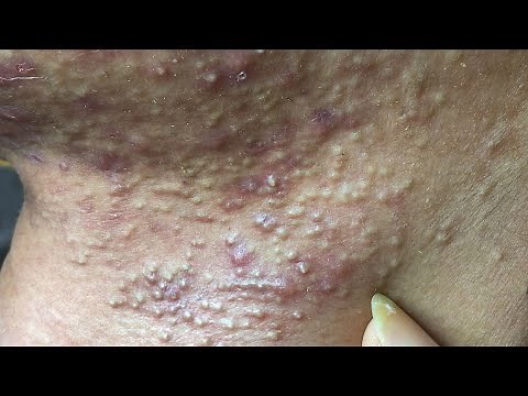 Acne Treatment For "Hung" (P8) | Điều Trị Mụn Cho Hùng (P8) - SacDepSpa#203