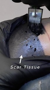 when you tattoo over scars, it breaks down the scar tissue, and will often be less raised when it heals | jonny.tatu