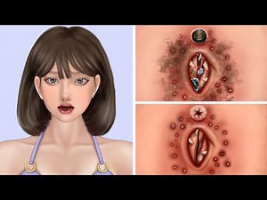 ASMR Remove Maggot & Worm Infected Belly | Deep Cleaning Animation