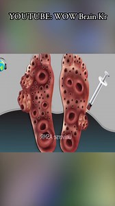 2.6K views · 31 reactions | ASMR Remove Worm & DogTick Infected Foot | ASMR Treatment Cleaning Animation #asmr #asmrsound #removal #treatment #animation #asmrvideo | WOW Brain | Facebook