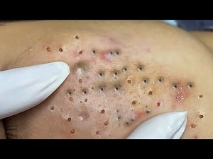 Blackheads and Acne Hide a lot near the neck