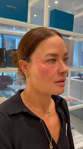 [REJURAN] Right after the treatment! The bumps settled down completely within just 2 hours. Rejuran is now available in our Sydney clinics. Originating from South Korea and approved in Australia, it revitalises skin by stimulating collagen production. Administered by our skilled doctors and nurses, Rejuran contains Polynucleotide Rejuran (PDRN), derived from salmon DNA, which promotes hydration, regeneration, and overall skin health. Our skin clinics are located in Barangaroo, Chatswood and Sydn