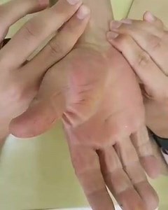 Allen's Test  Allen's test or the Allen test is a medical sign used...