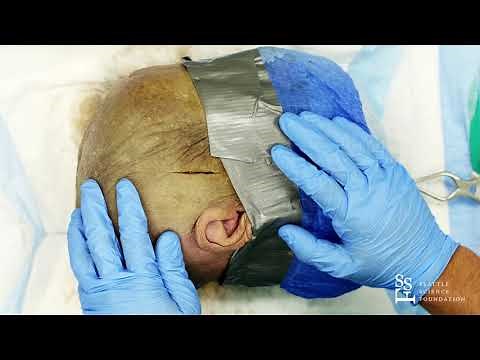 Emergency Burhol Craniatomy Juan