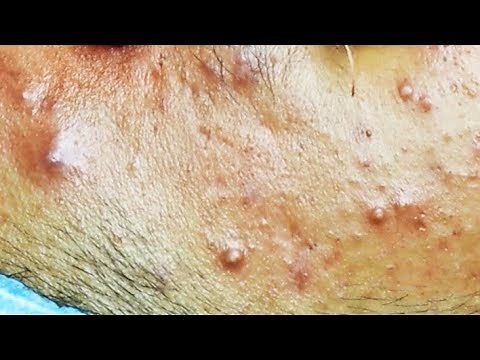 Extraction d'acné kystique et pustule | cystic acne