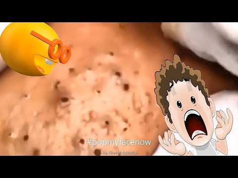 GREATEST ACNE EXTRACTION PART#14🎵🤓 [WHITEHEAD/BLACKHEAD] EXPLOSION 2020 #popmyfacenow