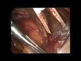 Laparoscopic TEP Repair for Bladder Hernia • Video • MEDtube.net