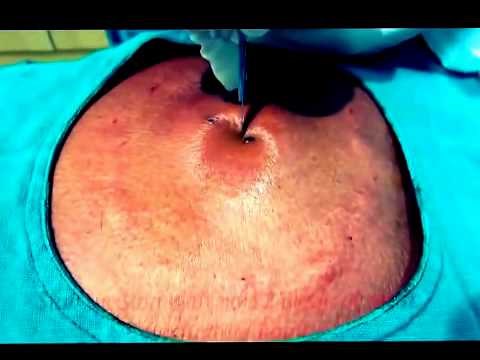 Back Abscess Cyst Huge Infected Sebaceous Popping Big Drainage Pus YouTube