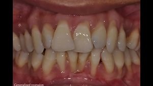 A Complex Perio-Ortho Case