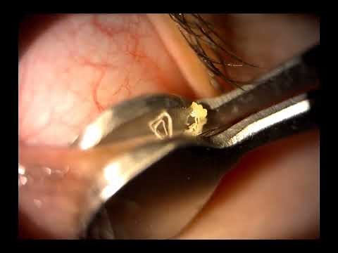 Meibomian Gland Expression: Treatment of Meibomian Gland Dysfunction (MGD)