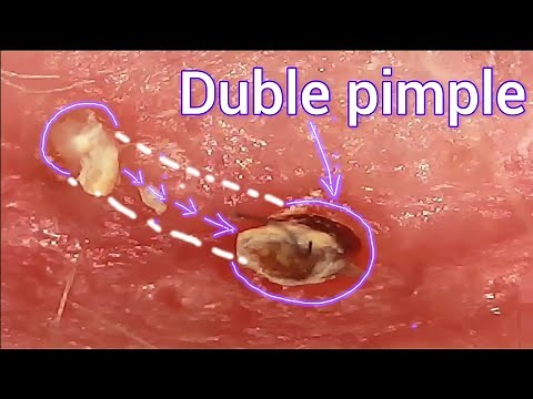Squeezing out a mutant pimple. Squeezing out pimples under a microscope Acne.