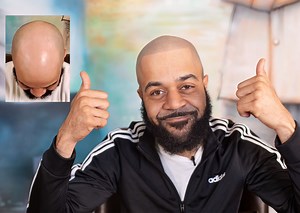 Where can I find scalp micropigmentation near me? - Scalp Micro USA