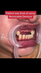 Patient was tired of using removable denture for a long time, she decided to have a permanent replacement of missing teeth using a Porcelain fused to Zirconia fixed bridge. #dentalfixedbridge #happypatient #happydentist #smiletransformation #dentalfixedbridge #porcelainfusedtozirconia #12units #cebudentists #cosmeticdentistry #docMaeSmile #ngitingDocMae #guadalupebranch #abroadPatient | Dr. Mae Abella Dental Clinic