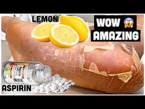 How to REMOVE CALLUSES AND CORNS from your feet organically using ASPIRIN