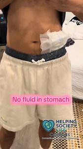 PD Dialysis isn’t a joke — this is my stomach with 0 ml vs 2200 ml of fluid. Not fat. Not bloating. Just the reality of staying alive. If you’re on PD too, you’re stronger than you know. 💛 Your transplant is coming. #PDDialysis #DialysisJourney #CKDWarrior #HelpingSociety #HelpingSocietyLifeConnects #viralreels #fypシ #DialysisSupport #explorepage #healthcare #savinglives Justin Pham #kidneywarrior | Helping Society LIFE Connects