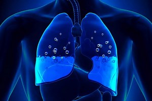Pleural effusion: what it is, what causes it and how to prevent it