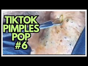 TIKTOK PIMPLES POP #6