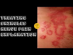 Treating Shingles Nerve Pain Explanation
